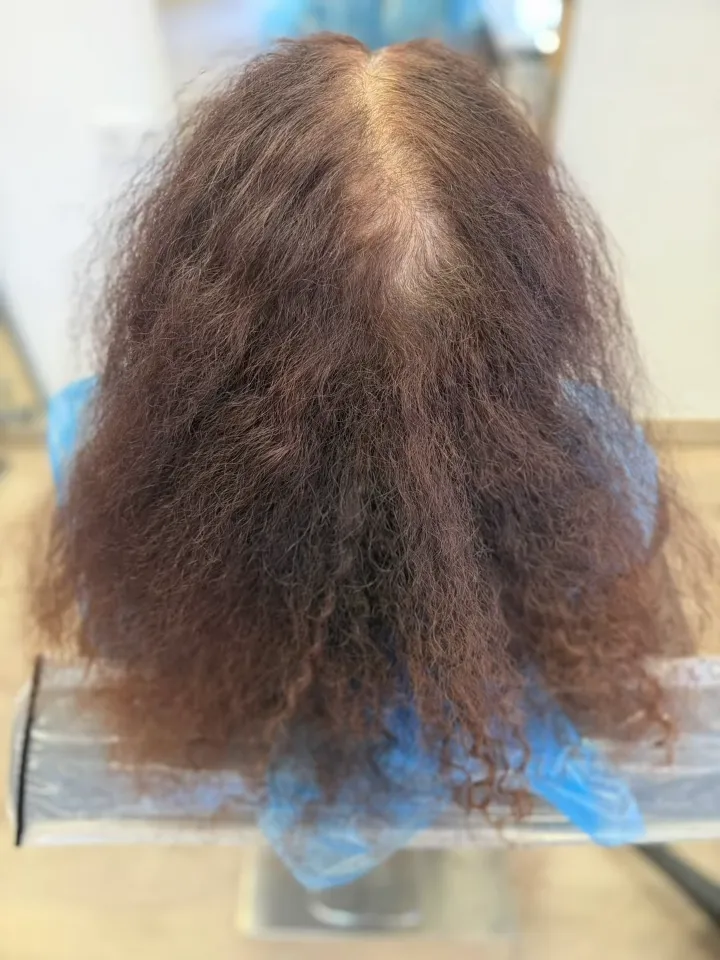 Antes: pelo oscuro encrespado, sin definición